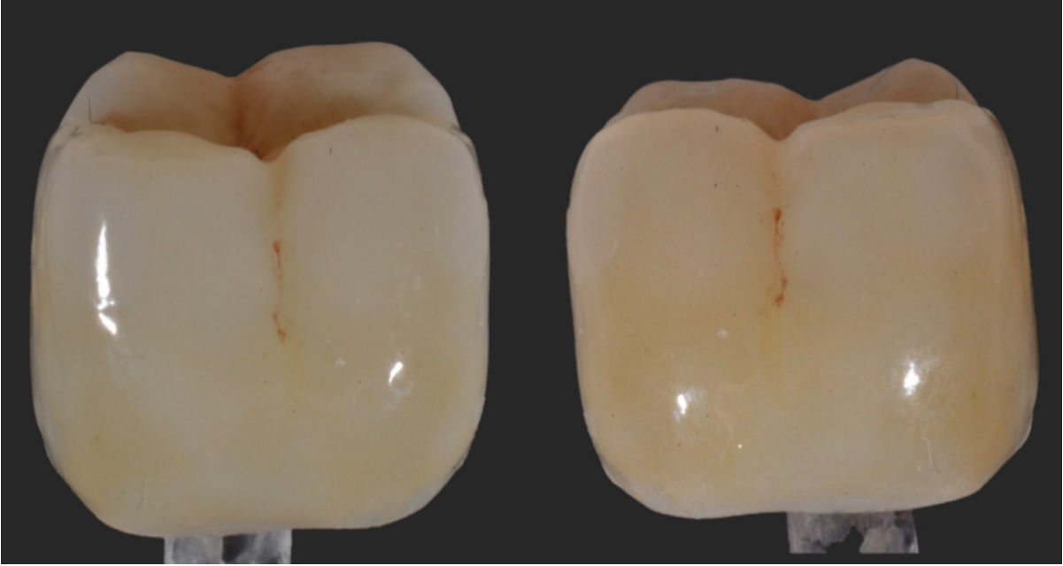 Corone in zirconia finalizzate