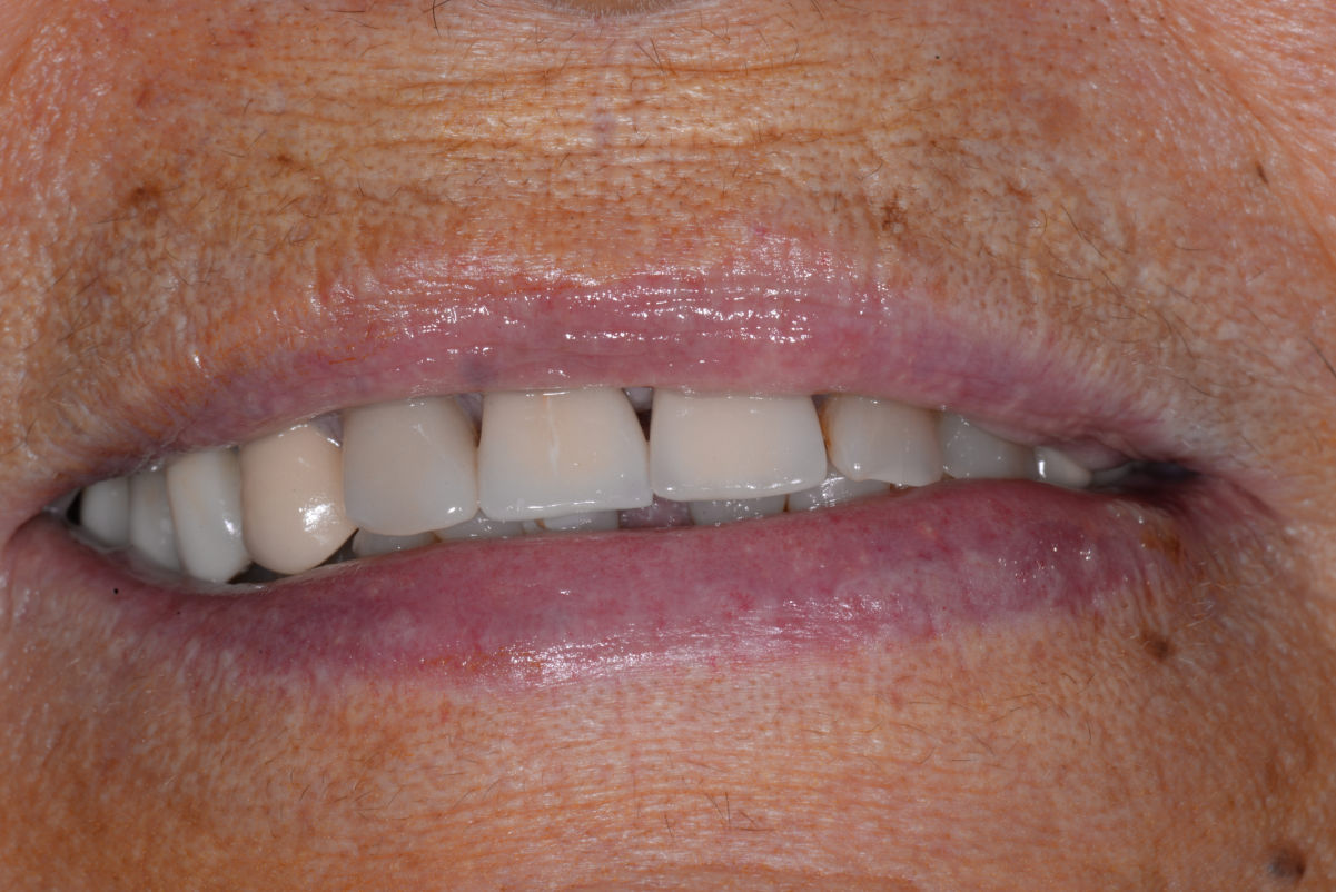 Fig. 3 - Sorriso della paziente, visione extraorale