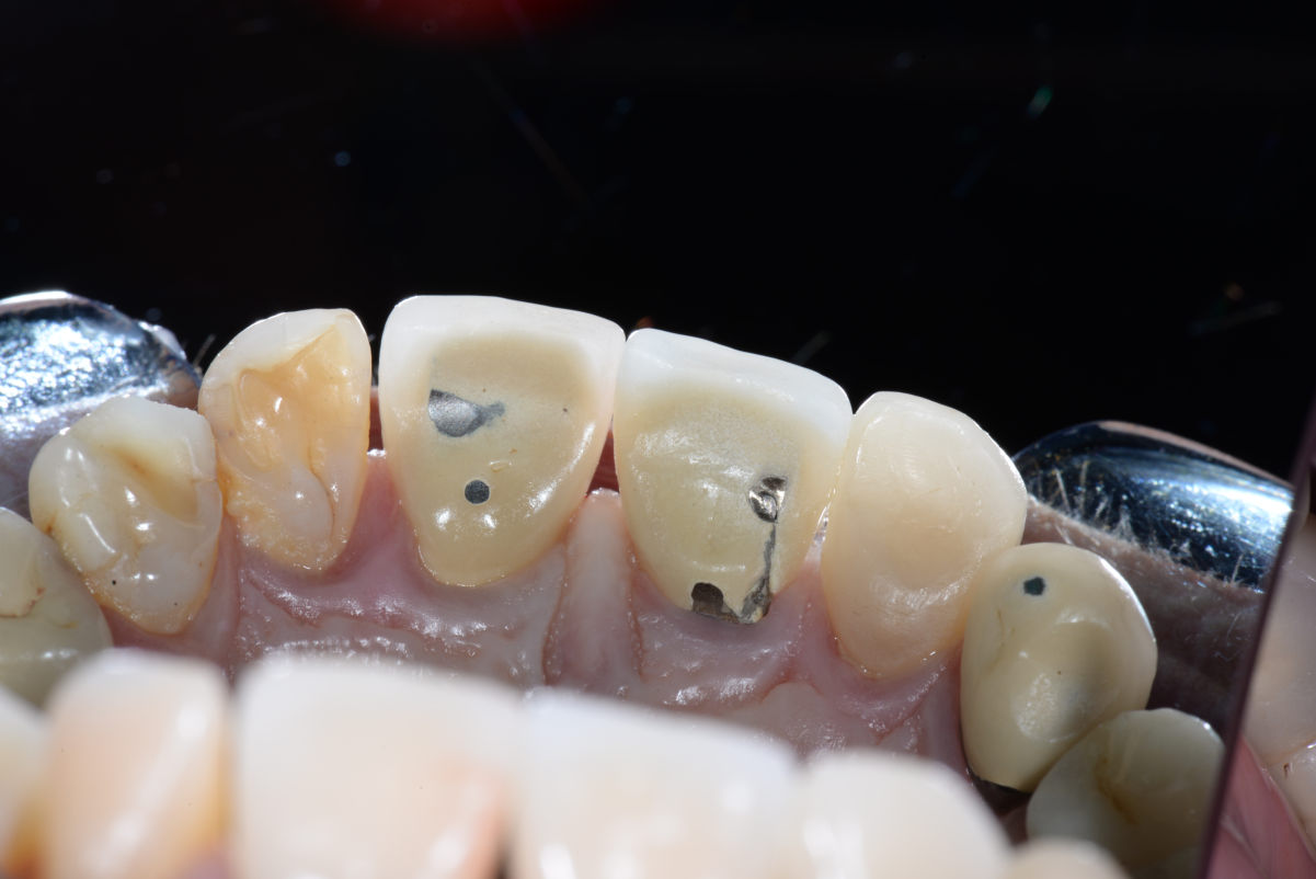 Fig. 4 - Visione occlusale degli incisivi superiori con i fori di accesso delle corone avvitate