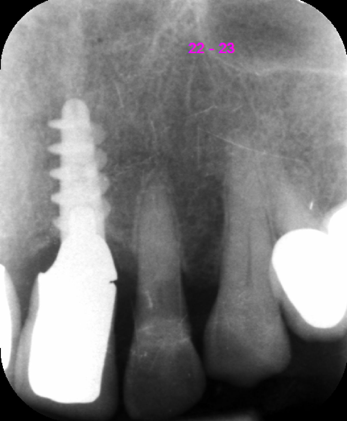 Fig. 5 - Radiografia endorale pre-operatoria