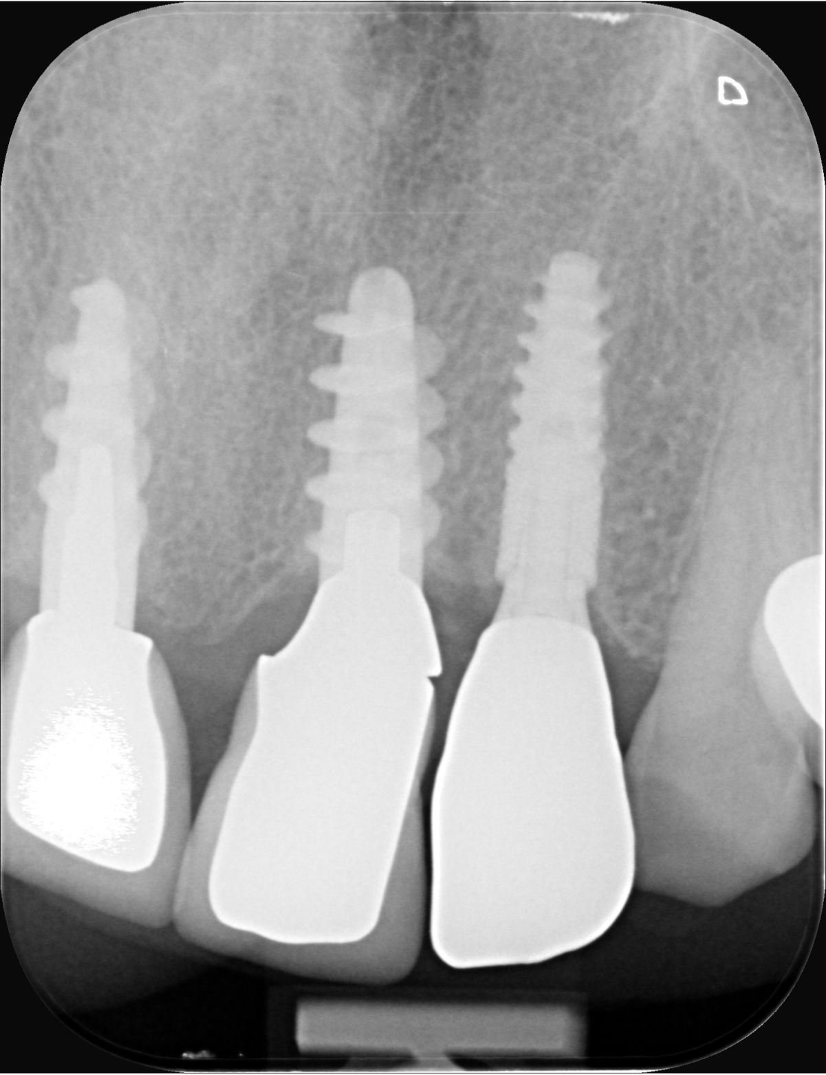 Fig. 6 - Radiografia endorale post-operatoria: impianti in sede 11, 21 e 22